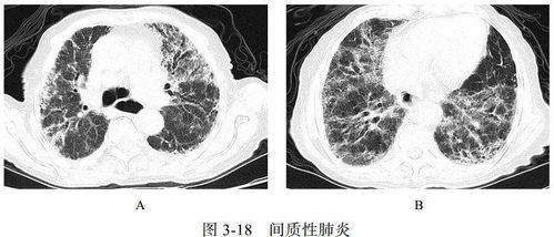 免疫治疗也会耐药？出现了耐药该怎么办？