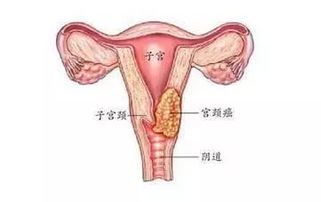 宫颈癌术后全身酸痛，是怎么回事？